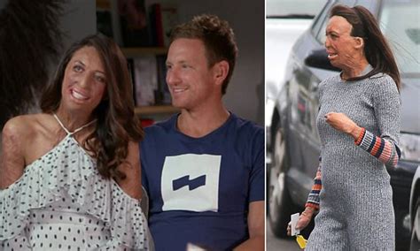 Turia Pitt Reveals How She Told Fiance She Was Pregnant Daily Mail Online
