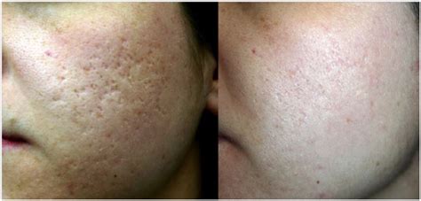 Laser Acne Scars Removal Treatment Pimples Treatment Kerala