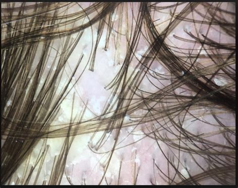 A person can use hypoallergenic products and make sure they completely rinse the shampoo off their hair and scalp. Seborrheic Dermatitis and Biotin: Is there a role ...
