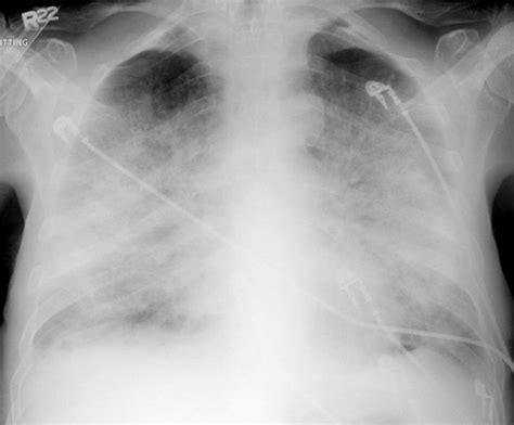 Do these tests require any special preparation? Chest Radiology