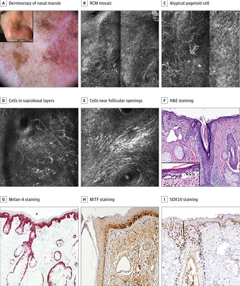 Histopathologic And Immunohistochemical Correlates Of Confocal