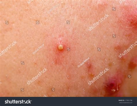 Acne Skin Because Disorders Sebaceous Glands Stock Photo 177851798