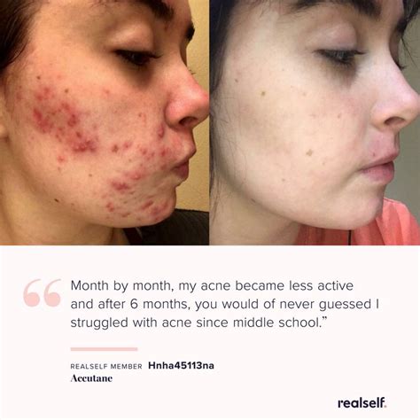 Accutane Side Effects Uses Results And More Realself Acne Treatment