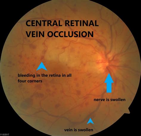 Vein Occlusion What Is It Sk Retina Specialist In Sarasota