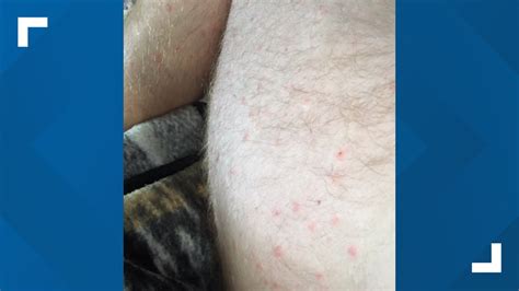 Do You Know What A Seed Tick Bite Looks Like Check It Out