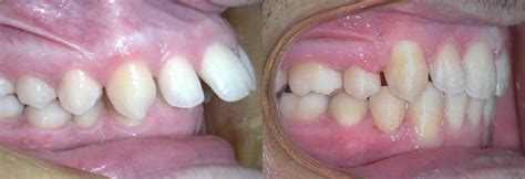 Before And After Castella Orthodontics Emeryville On