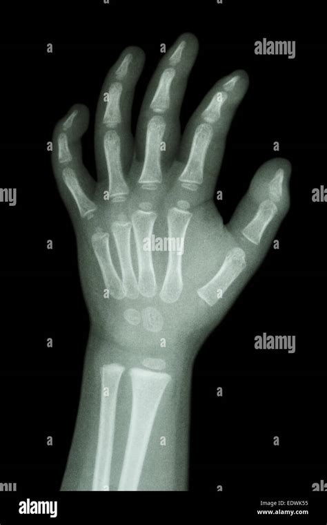 Child Hand X Ray Hi Res Stock Photography And Images Alamy