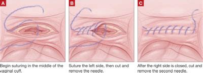 Barbed Suture Now In The Toolbox Of Minimally Invasive Gyn Surgery