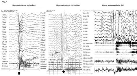 Epilepsy With Myoclonic Atonic Seizures Also Known As Doose Syndrome