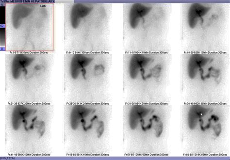 Technetium 99m Labeled Mebrofenin Hepatobiliary Scan Without