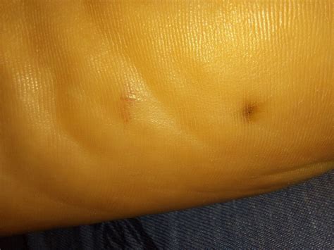 What Could This Black Spot On My Foot Be Mumsnet