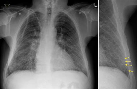 Pulmonary edema, or fluid in the lungs or water in the lungs, is a condition in which fluid fills the alveoli in the lungs. Pulmonary oedema - renal failure - Radiology at St ...