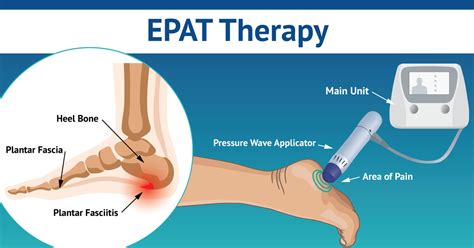 Relieve Foot Pain With Epat Therapy Metro Tulsa Foot Ankle