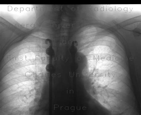 Radiology Case Cervical Rib Megatransverse Process Unilateral