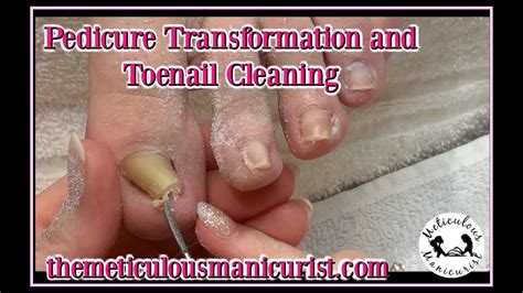 pedicure transformation tutorial deepest ingrown toenail or pincer toenail youtube