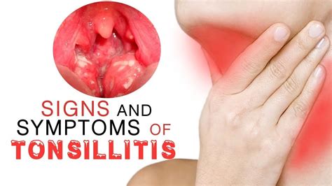 Signs And Symptoms Of Tonsillitis Youtube