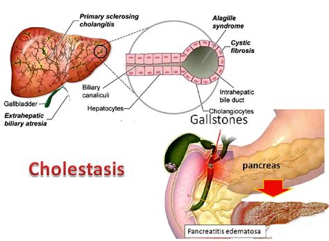 Liver Cholestasis Types Causes Features Symptoms Diagnosis And