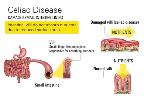 Celiac Disease