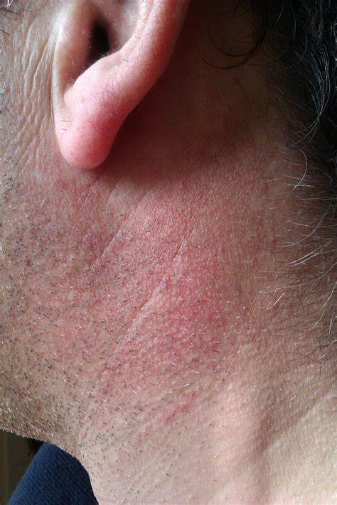 Itchy Rash On Neck And Behind Ears Seborrheic Dermatitis Seborrheic