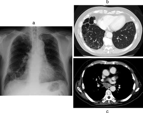 Infectious Mediastinal Lymphadenopathy After Repeated Transbronchial