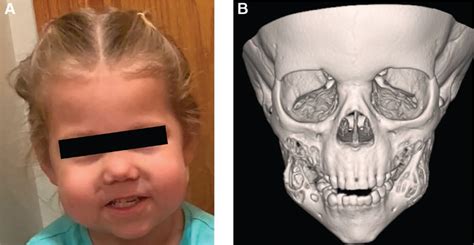 Severe Cherubism Treated With Curettage Osteotomy And Bony Plastic And Reconstructive