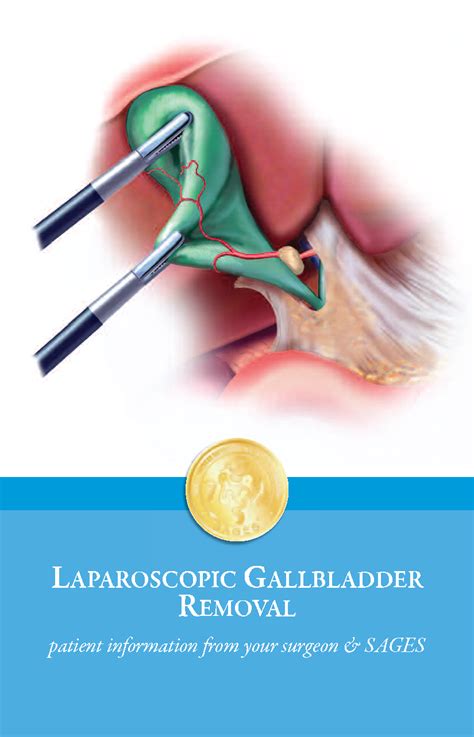 Laparoscopic Cholecystectomy Artofit