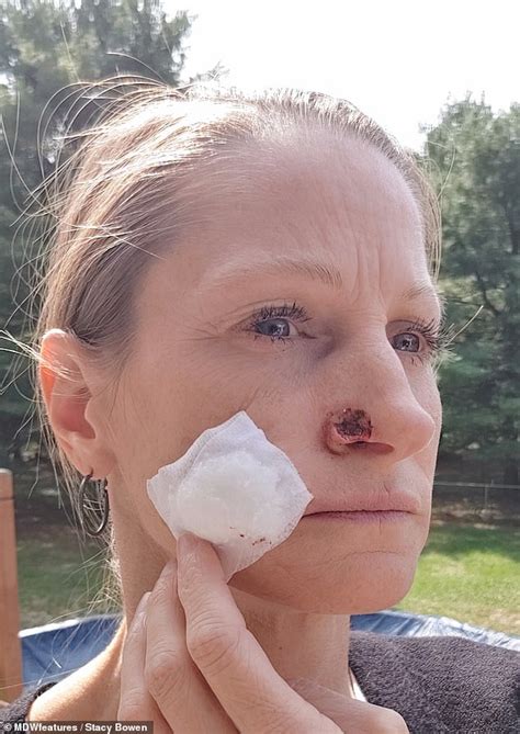 Mother Of Two Had A Chunk Of Her Nostril Removed After Being Diagnosed