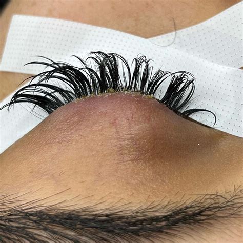 Can You Get Blepharitis From Eyelash Extensions