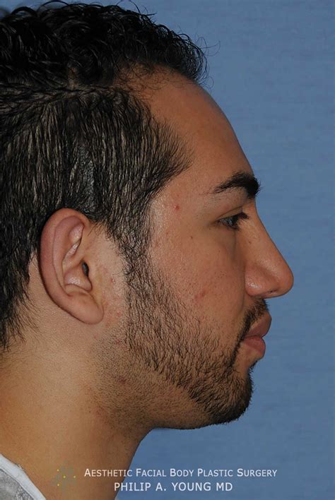 Chin Implant Reshaping Before And After Photos