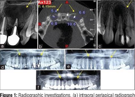 figure 1 from management of bilateral radicular cyst in the permanent maxillary lateral incisors