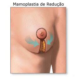 Cirurgia Pl Stica De Mamoplastia Redutora Pre O