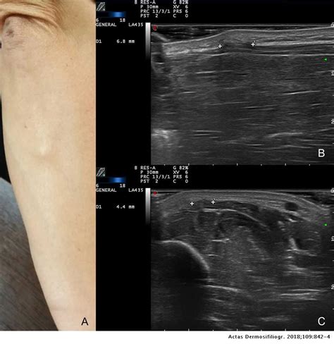 The Utility Of Ultrasound In The Diagnosis Of Muscle Hernias In The