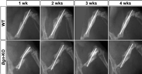 The bone healing process has three overlapping stages: X-ray analysis of fractured bone with healing. Femurs from ...