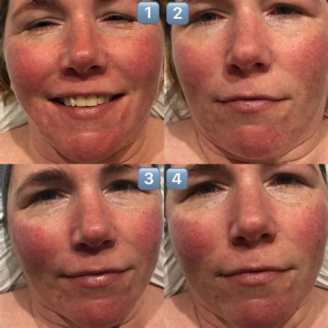Treating My Rosacea With An Ipl Skin Rejuvenation Course Chelseamamma