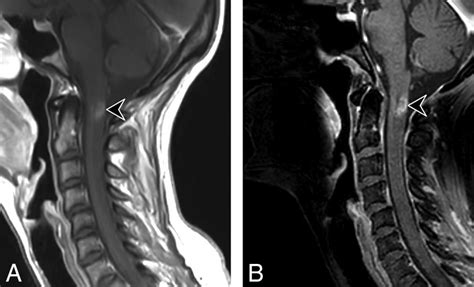 A T Phase Sensitive Inversion Recovery Mri Sequence Improves Detection Of Cervical Spinal Cord