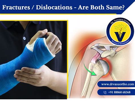 Fractures And Dislocations Treatment Dr Vasudev Juvvadi