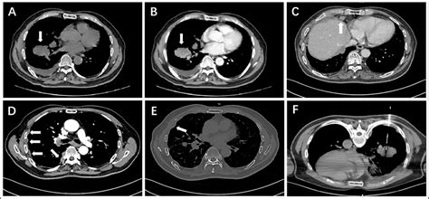 Ct Images Show A Lobulated Mass In The Right Lower Lobe Of The Lung A