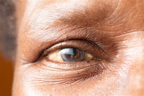 How Do You Know When To Have Cataract Surgery Eye Center Of Texas