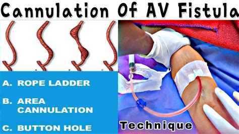 How To Cannulate Fistula Types Of AV Fistula Cannulation YouTube