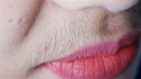 Facial Hair Pcos Hair On Face Herzindagi