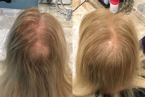 Microneedling With PRP Evansville PRP Hair Restoration Evansville IN