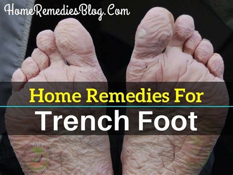 5 Best Home Remedies For Trench Foot Home Remedies Foot Remedies Remedies