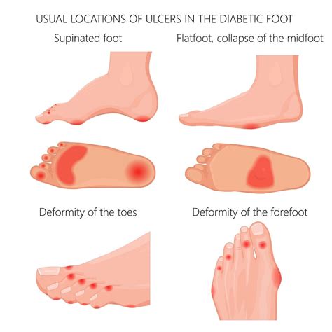 Charcot And Diabetic Foot Symptoms Diagnosis And Treatments