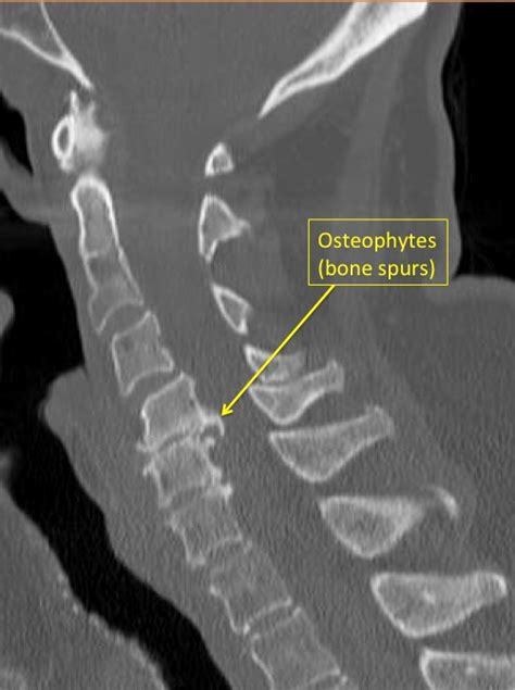 Cervical Spine Anatomy Diseases And Treatments
