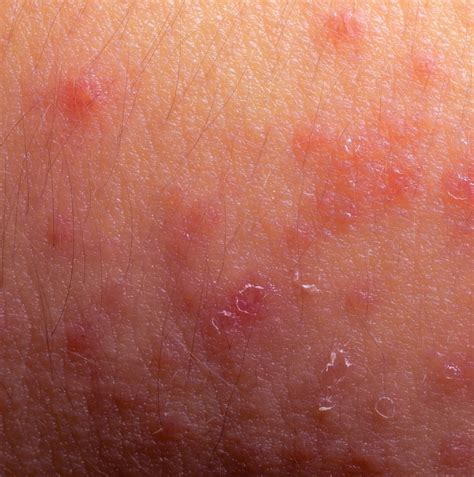 Dermatite De Contato Sintomas E Tratamento Foto Preven O The Best