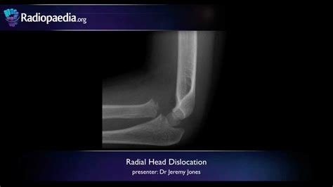 Radial Head Dislocation Radiology Video Tutorial X Ray Youtube