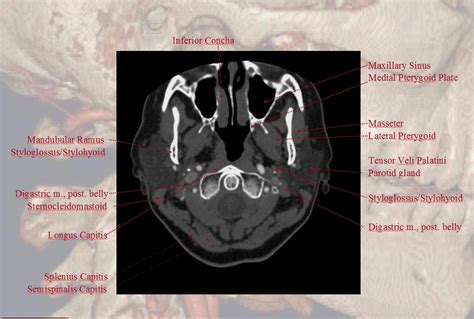 Ct Scan Brain Angiography Anatomy Ct Scan Machine