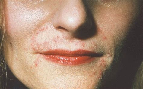 Skin Conditions That Look Like Acne But Arent Best Health Canada