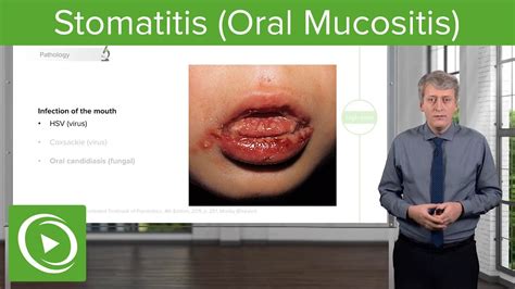 Stomatitis Oral Mucositis Pediatric Infectious Diseases Lecturio