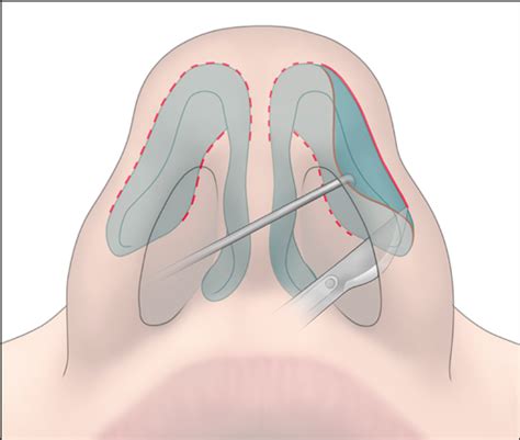 Nasal Tip Recontouring In Primary Rhinoplasty The Endonasal Complete